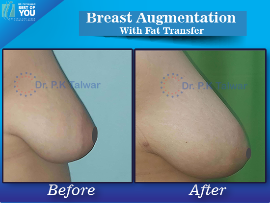 Breast Augmentation with fat injection result